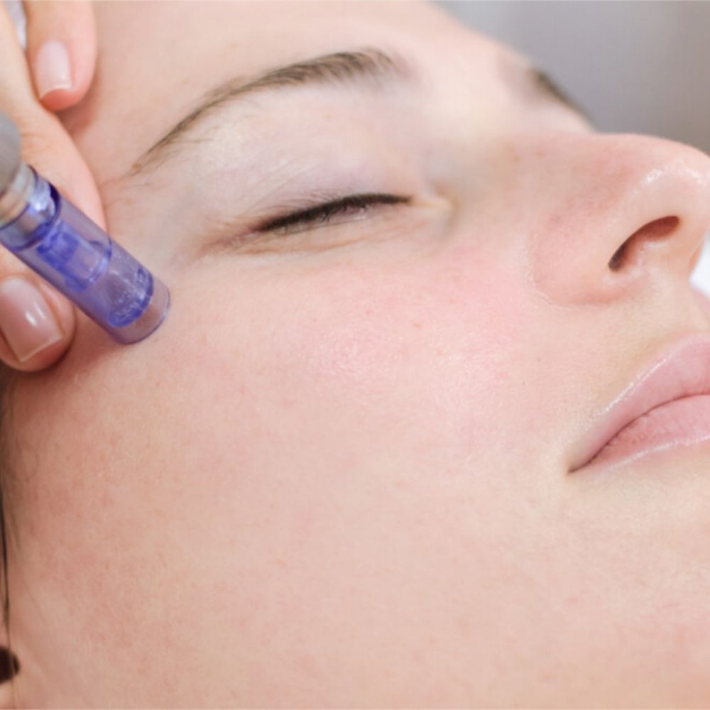 Microneedling