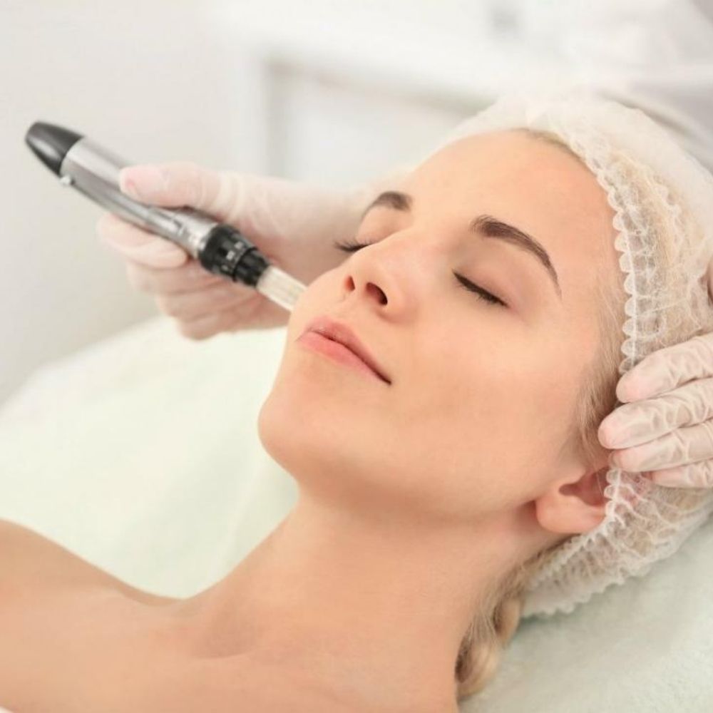 Microneedling RF