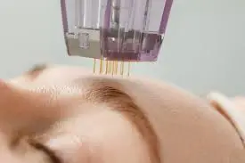 Microneedling device with fine needles applied to forehead during PRP facial treatment at Skinfluence Aesthetics