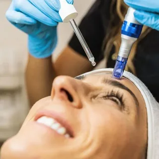 PRP Facial treatment at Skinfluence Aesthetics with platelet-rich plasma injection on forehead for skin rejuvenation