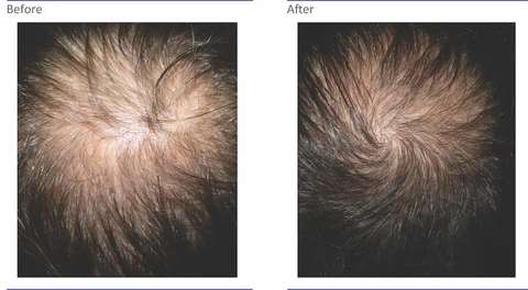 PRP hair restoration before and after results showing improved hair density at Skinfluence Aesthetics