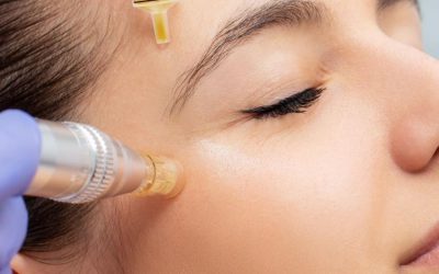 Microneedling