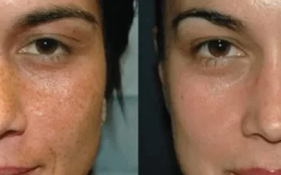 imgi_9_VI-Peel-qtmjqxhi2ip2r1l7v4nj7xrsyhffbi5t8wlq3kscec